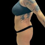 VASER Liposuction Before & After Patient #3157