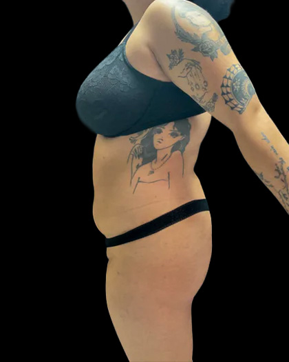 VASER Liposuction Before & After Patient #2614