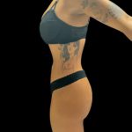 VASER Liposuction Before & After Patient #3157