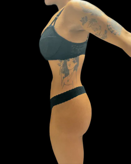 VASER Liposuction Before & After Patient #2614