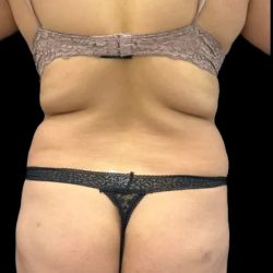 Brazilian Butt Lift Before & After Patient #2644