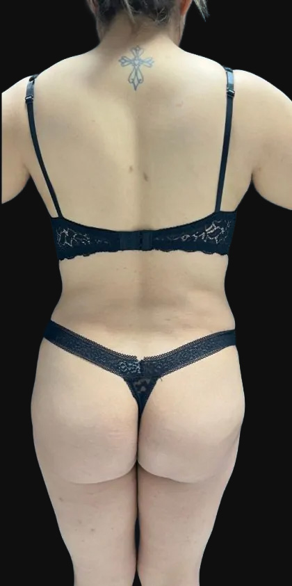 Brazilian Butt Lift Before & After Patient #2644