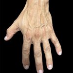Hand Filler Before & After Patient #2990