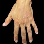 Hand Filler Before & After Patient #2990
