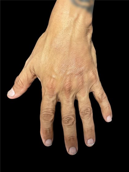 Hand Filler Before & After Patient #2990