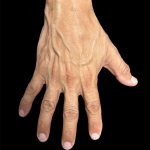 Hand Filler Before & After Patient #2990