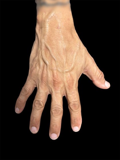 Hand Filler Before & After Patient #2990
