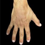 Hand Filler Before & After Patient #2990