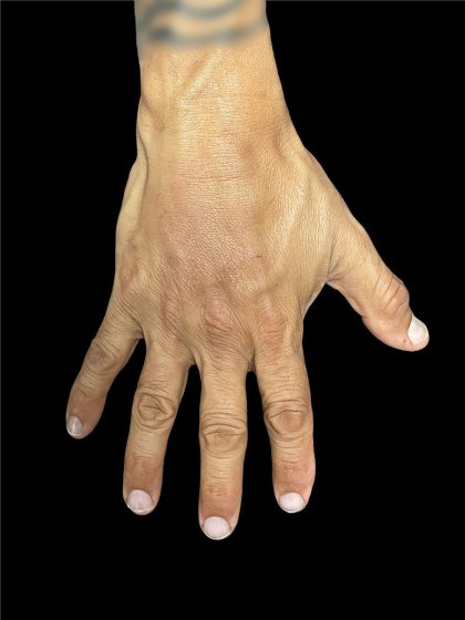 Hand Filler Before & After Patient #2990