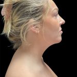 VASER Liposuction Before & After Patient #2994