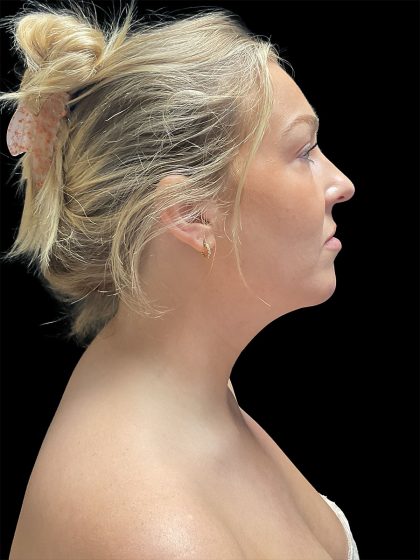 VASER Liposuction Before & After Patient #2994