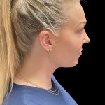 VASER Liposuction Before & After Patient #2994