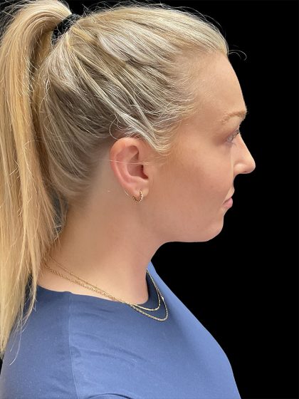 VASER Liposuction Before & After Patient #2994