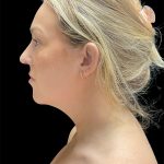 VASER Liposuction Before & After Patient #2994