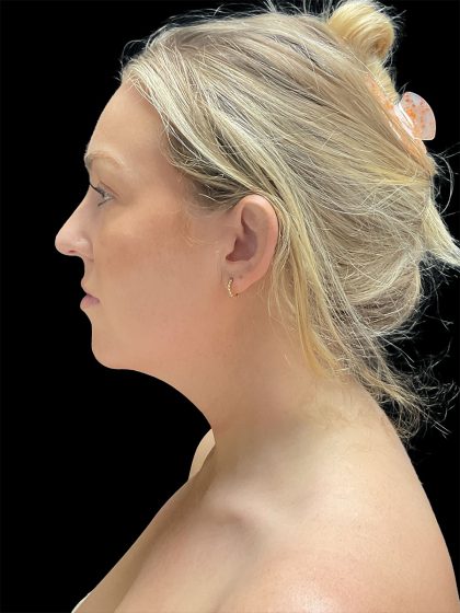 VASER Liposuction Before & After Patient #2994