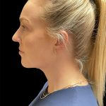 VASER Liposuction Before & After Patient #2994