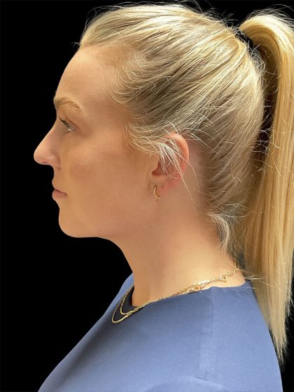 VASER Liposuction Before & After Patient #2994