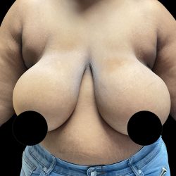 Breast Reduction Before & After Patient #2996