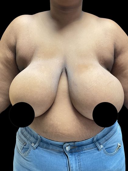 Breast Reduction Before & After Patient #2996