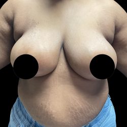 Breast Reduction Before & After Patient #2996