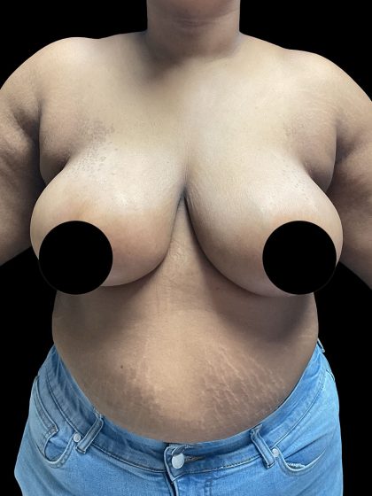Breast Reduction Before & After Patient #2996