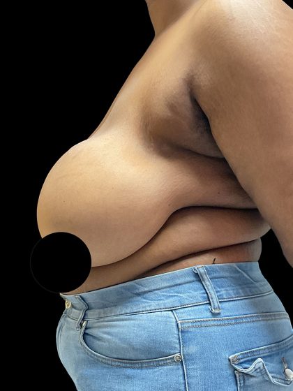 Breast Reduction Before & After Patient #2996