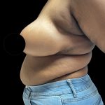 Breast Reduction Before & After Patient #2996