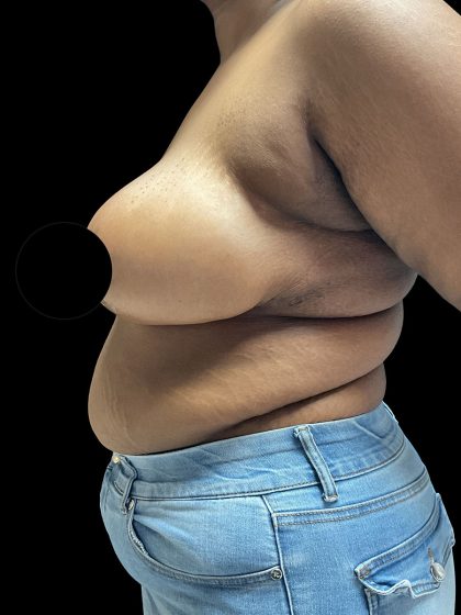 Breast Reduction Before & After Patient #2996