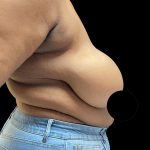 Breast Reduction Before & After Patient #2996