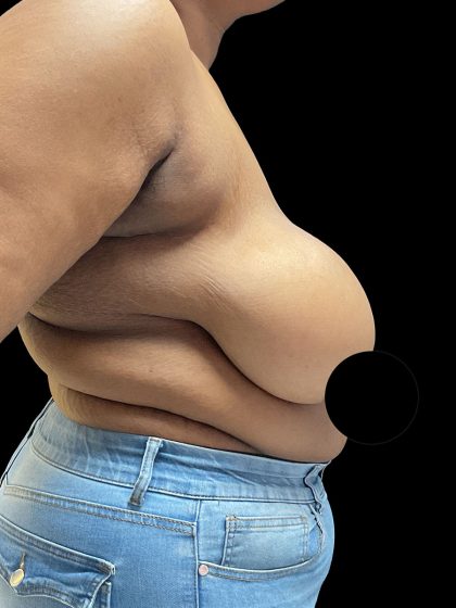 Breast Reduction Before & After Patient #2996