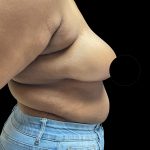 Breast Reduction Before & After Patient #2996
