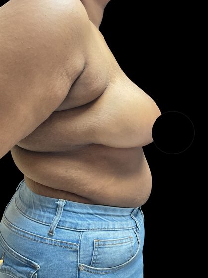 Breast Reduction Before & After Patient #2996