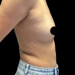 Breast Augmentation Before & After Patient #2998