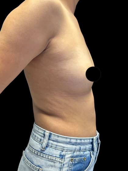 Breast Augmentation Before & After Patient #2998