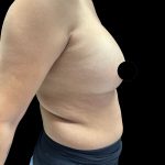 Breast Augmentation Before & After Patient #2998