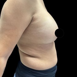 Breast Augmentation Before & After Patient #2998