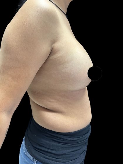 Breast Augmentation Before & After Patient #2998