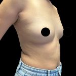 Breast Augmentation Before & After Patient #2998
