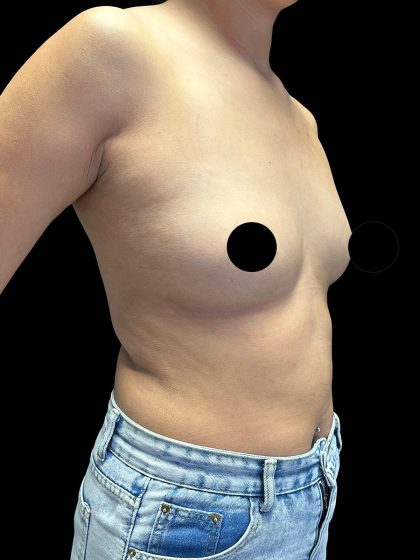 Breast Augmentation Before & After Patient #2998