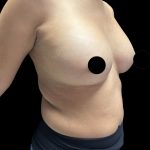 Breast Augmentation Before & After Patient #2998