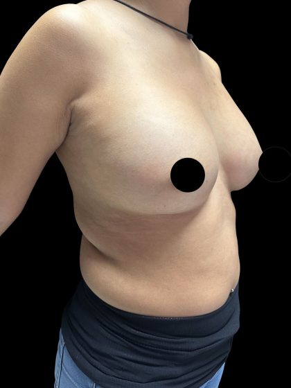 Breast Augmentation Before & After Patient #2998