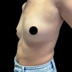 Breast Augmentation Before & After Patient #2998