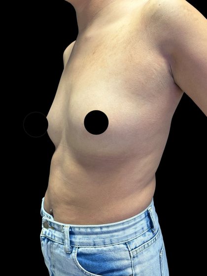 Breast Augmentation Before & After Patient #2998