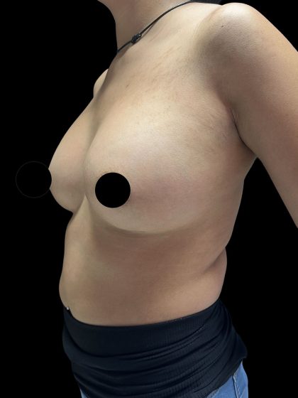 Breast Augmentation Before & After Patient #2998