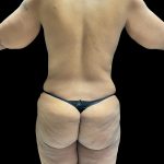 Brazilian Butt Lift Before & After Patient #2987
