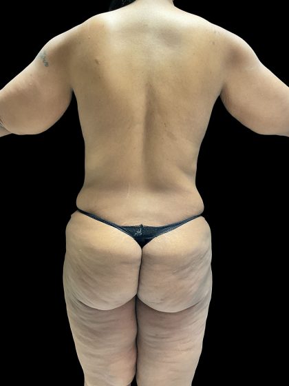 Brazilian Butt Lift Before & After Patient #2987