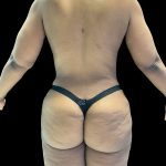 Brazilian Butt Lift Before & After Patient #2987