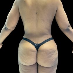Brazilian Butt Lift Before & After Patient #2987
