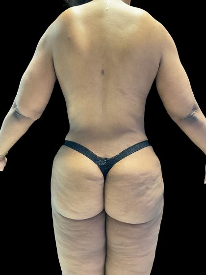 Brazilian Butt Lift Before & After Patient #2987
