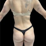 Brazilian Butt Lift Before & After Patient #2988